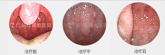 咽炎怎么治才好得快?