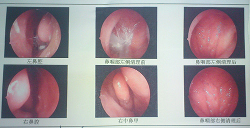 过敏性鼻炎能看好吗?治疗方法是什么?作者:南京仁品 点击:162